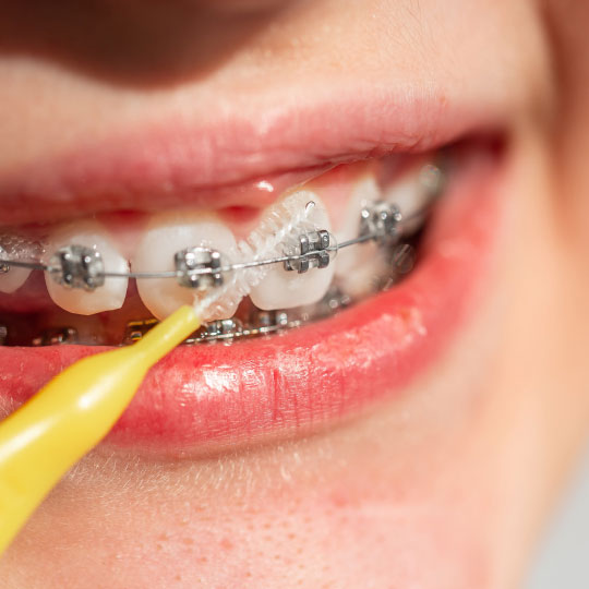Zahnprophylaxe für Teens zahnarzt